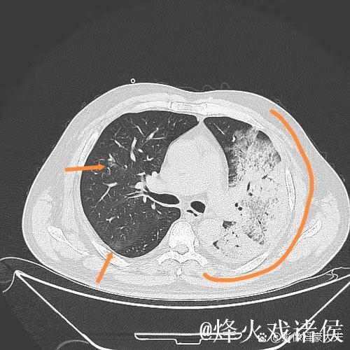 埃迪-豪：得肺炎住院后，意识到医疗体系与医护人员至关重要